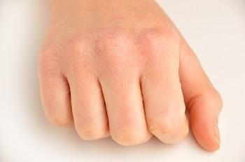 Chapped hands can be painful