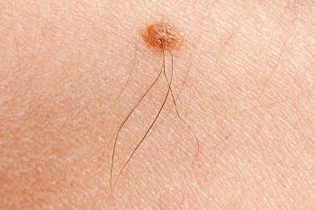 Melanoma Mole
