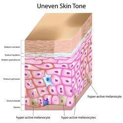 Hyperpigmentation