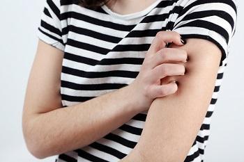 Hive outbreaks can be very itchy