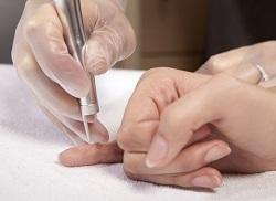 Treatment of warts