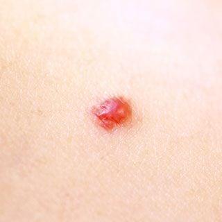 Cherry Angiomas - Azalea Skin Treatment Center | Garner, NC Dermatologist